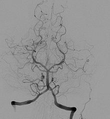 220px-Cerebral_angiography,_arteria_vertebralis_sinister_injection
